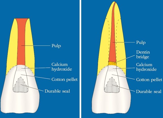 ápice abierto y uno cerrado en endodoncia