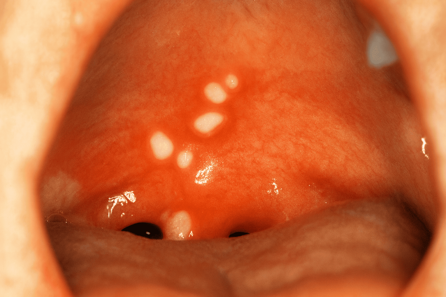Herpangina y lesiones virales en cavidad oral