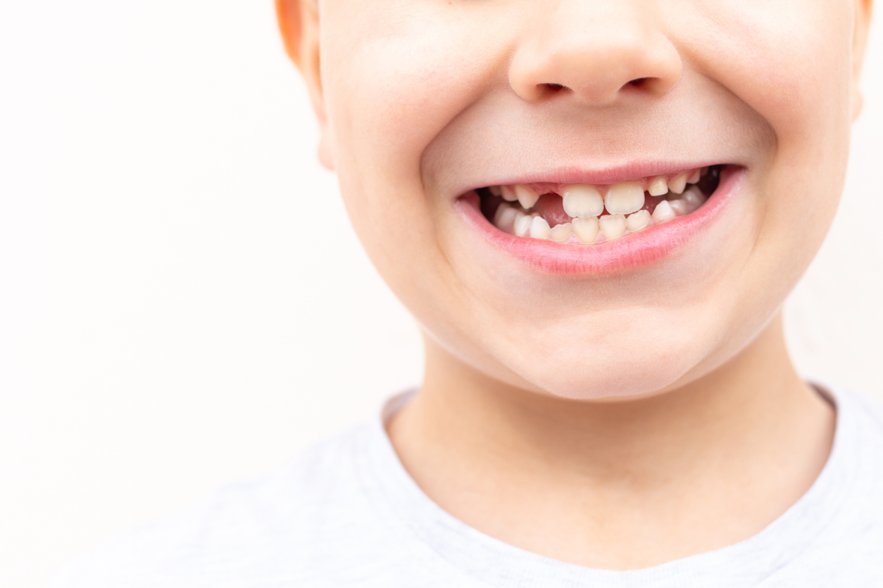 Consecuencias de no Corregir la Mala Alineación Dental