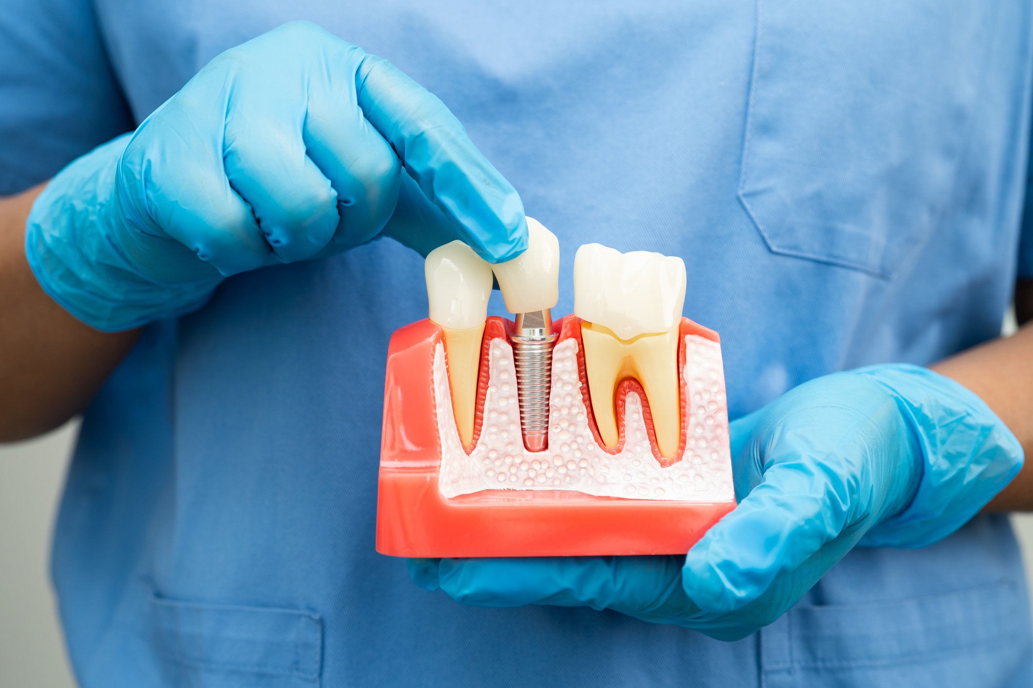 Molestias Normales Tras un Implante Dental