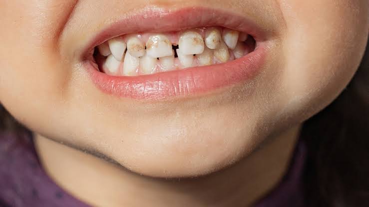 Hipoplasia del Esmalte en Niños
