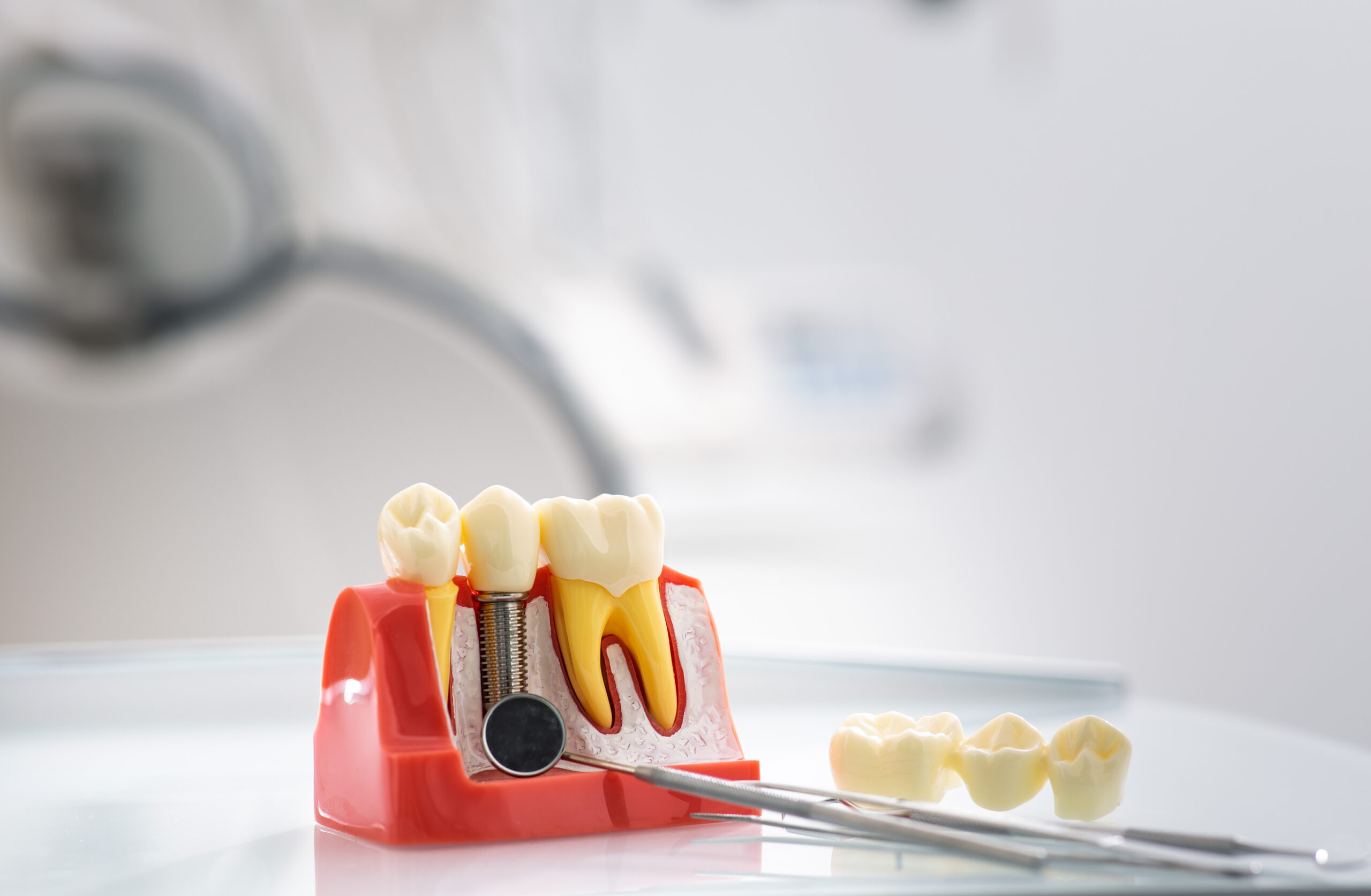 Implantes dentales en personas mayores